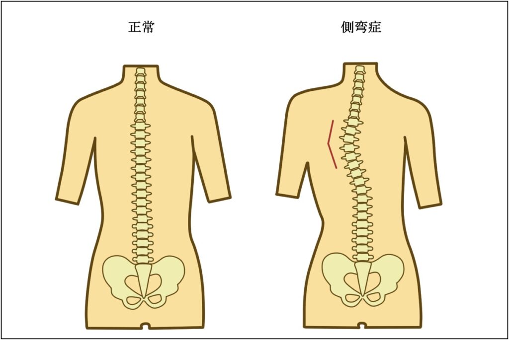 側湾症図解イメージ